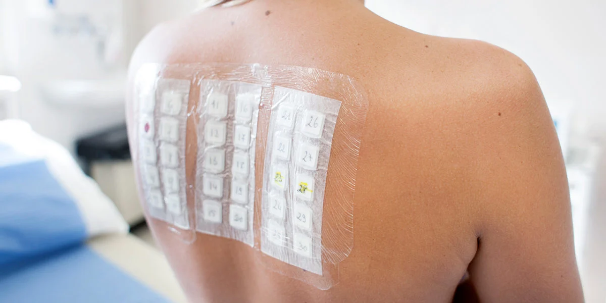 Titanium Biocompatibility and Food Grade Titanium: What the Standards Actually Say (And What They Don’t) 7 Metal allergy patch testing on patient's back - dermatology patch test for titanium and nickel sensitivity